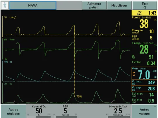 Figure  10  Capture  d’écran  d’un  patient  en  mode  NAVA. Au  cours  de  l’insufflation,  la  Paw  est  à  chaque  instant égale à la valeur de l’EAdi (en μvolt) multipliée par le niveau de NAVA (en cm H 2 O.μvolt -1 )