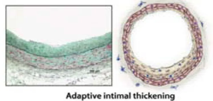 Figure 2. Photograph and representative diagram of a human coronary artery showing adaptive  intimal thickening of arteries