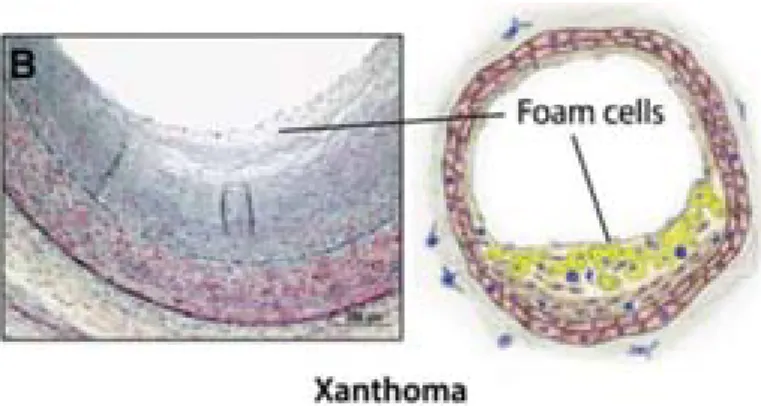 Figure 3. Photograph and representative diagram of a human intimal xanthoma. This lesion displays  an accumulation of foam cells derived from recruited macrophages and SMCs (adapted from Bentzon,  2014)