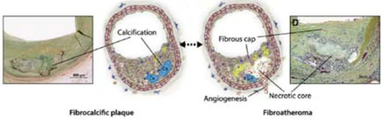 Figure 5. Representative diagrams and photographs of a human fibrocalcific plaque and a 