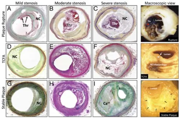 Figure 6. Microphotographs of histological sections and macroscopical views of disrupted,  vulnerable (TCFA), and stable plaques with different degrees of stenosis