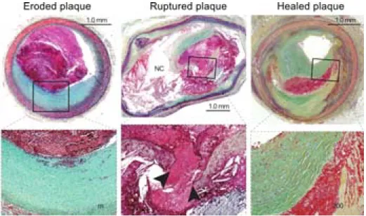 Figure 7. Microphotographs and magnifications of an eroded plaque, a ruptured plaque and a healed  plaque