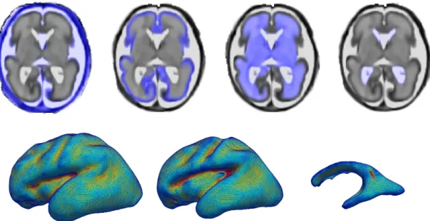 Illustration de segmentation utilisant un atlas statistique personnalisé: cartes de probabilité estimées superposées sur  l’image 3D reconstruite et maillages associés (surface corticale, interface substance blanche / cortex, ventricules)