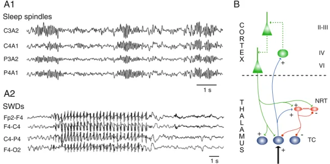 Fig. 1 Sleep spindles and spike and waves discharges (SWDs) of absence epilepsy. A1 Sleep spindles recorded during natural sleep from four standard EEG derivations in a normal subject during stage 2 of NREM sleep