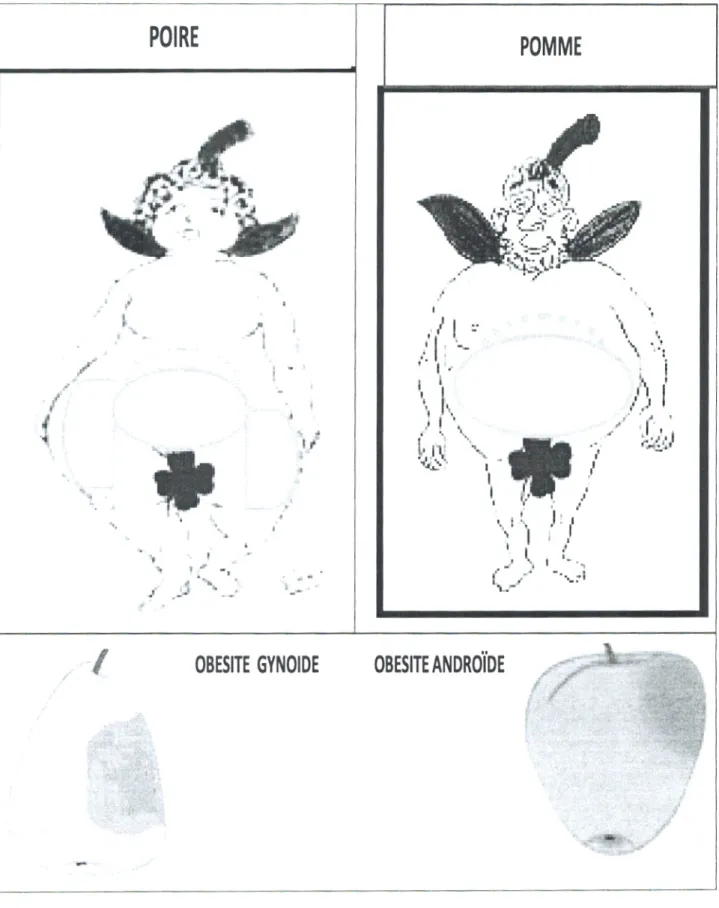 Figure 2. Obésité ganoïde et androïde  (PHILIPPE, 2011) 