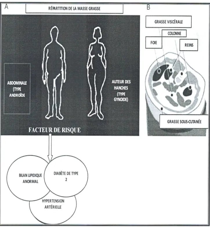 Figure 3. Obésités androïde et gynoïde et facteurs de risques (A). La graisse abdominale est répartie  entre deux compartiments: dépôt sous-cutané et dépôt viscéral (B)