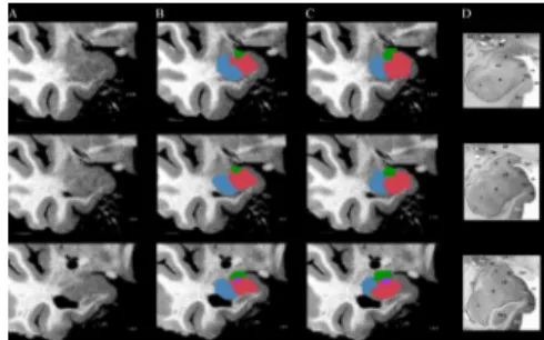 Figure 2. Manual vs. tractographic segmentation