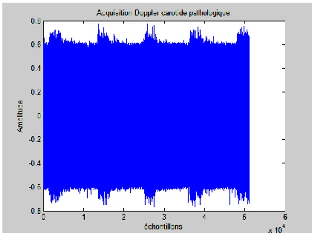 Figure 3.7.  Signal ultrasonore Doppler de l’artère carotide 