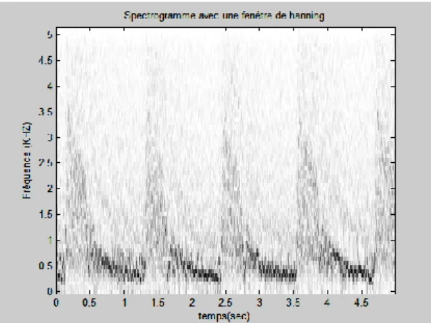 Figure 4.8.b. Représentation temps-fréquence du signal Doppler de l’artère carotide  (Cas pathologique)