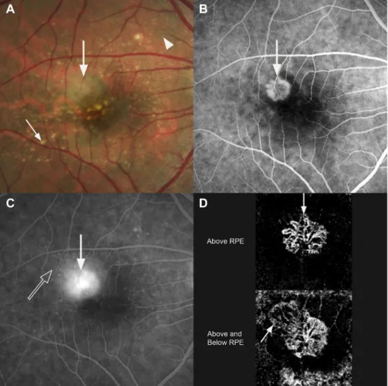 Figure 15. Images showing mixed type 1 and type 2 macular neovascularization. A, Fundus photograph from 62-year-old showing a region of yellowish exudation (larger arrow)