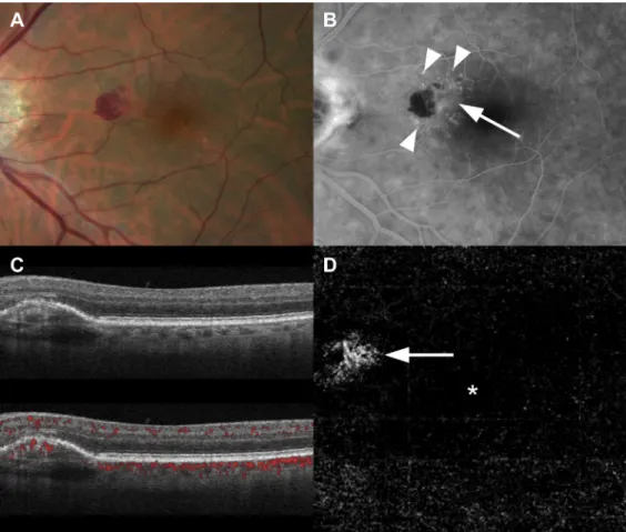Figure 5. Images showing type 1 macular neovascularization. A, Fundus photograph from a 78-year-old with hemorrhage in the nasal macula