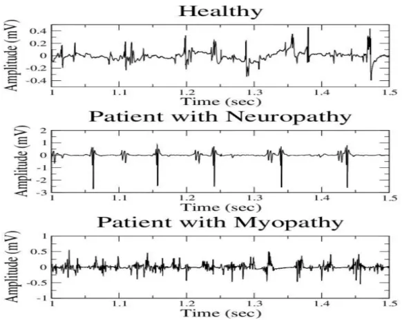 Figure I.8 : Tracés du signal EMG normal et pathologique : le premier signal obtenue d’un  patient sain, le deuxième signal d’un patient avec neuropathie et le  troisième d'un cas atteint de 