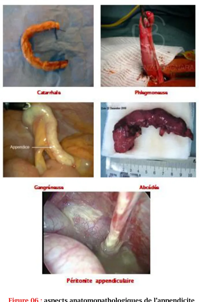 Figure 06 : aspects anatomopathologiques de l’appendicite  