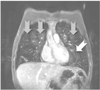 Figure    15.    Illustration    d'artéfacts    d'origine    cardiaque    se    projetant    dans    les    poumons,    dans    la    direction    de    la    phase    (droite-­‐gauche)    :    image    fantôme    du    ventricule    gauche    (flèche    b