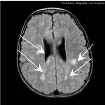 Fig 1.  Transaxial slice brain image corresponding    to child of the 8 year old with tumours depicted