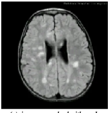 Fig 2.  Pathological  image convolved with a Gaussian  filter G σ    