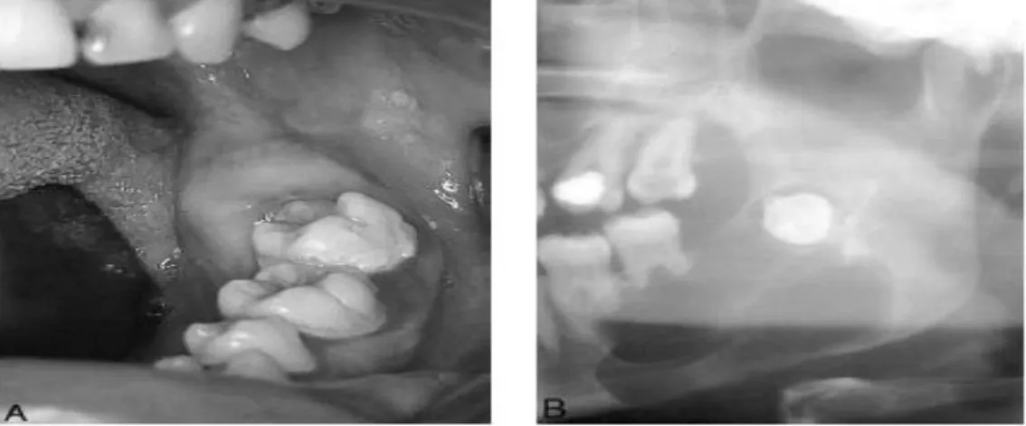 Figure 12. Image radiologique d’un Kyste péricoronaire   de l’angle mandibulaire gauche