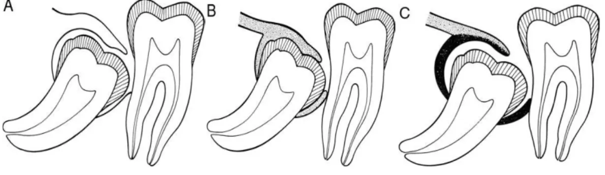 Figure 13. Schémas récapitulatif des conditions de développement   d’une péricoronarite sur les 3 èmes  molaires inférieures