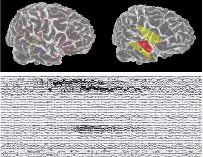 Figure 6. Example of simulated sEEG-recorded seizure. A large-scale network is composed of 190  nodes (top left, red dots), which are connected via weights derived from diffusion weighted imaging  data establishing the structural connectome