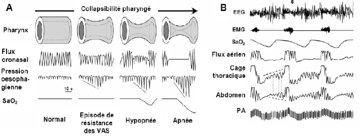 Figure 4 : Evénements respiratoires lors d’un collapsus pharyngé et enregistrement  polysomnographique, d’après Dematteis et al, 2009 [37] 