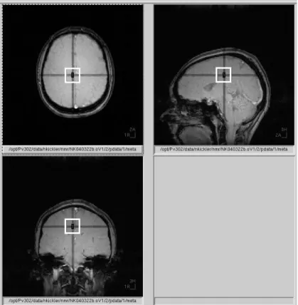 Fig.  2.12  shows  the  voxel  from  which  the  double  quantum  filtered  spectrum  has  been  acquired,  positioned  on  the  axial,  frontal  and  transverse  scout  images