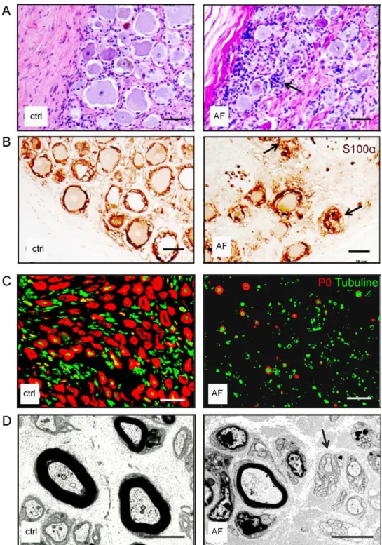 Figure 10 : Dégénérescence des larges neurones des DRG et neuropathie sensitive. 