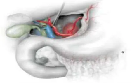 Figure 1:dissection du pédicule hépatique 