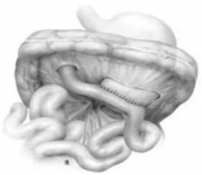 Figure 10 : anastomose gastro-jéjunale. 