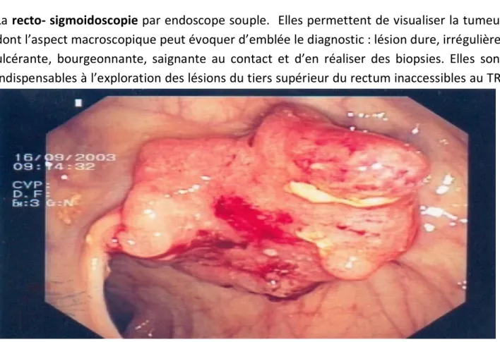 Figure 13 : Rectosigmoidoscopie : cancer du rectum situé à 10 cm de la marge anale [8] 
