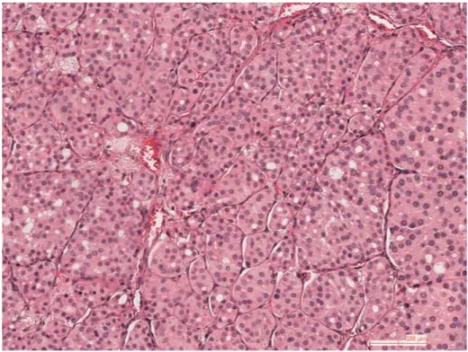 Figure 8. Carcinome de souche vésiculaire peu différencié. 