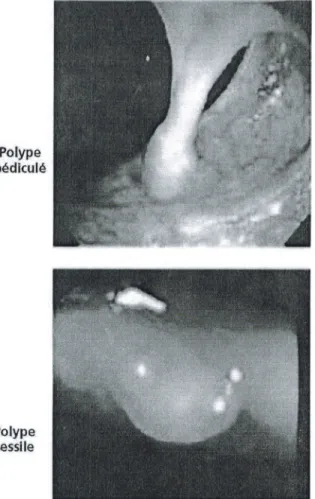 Fig. 9.1. Aspect macroscopique des polypes en  coloscopie 