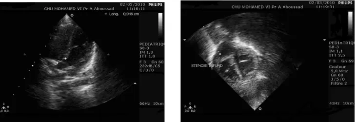Figure 13 (à droite): Vue apicale des 4 cavités avec aspect de communication interventricualaire haute et  dextroposition de l’aorte en rapport avec une tétralogie de Fallot 