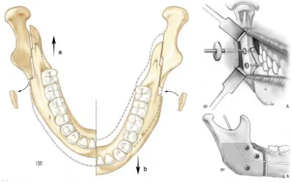 Figure   13   :   à   gauche   déplacement   sagittal   mandibulaire   (avancée   ou   recul)