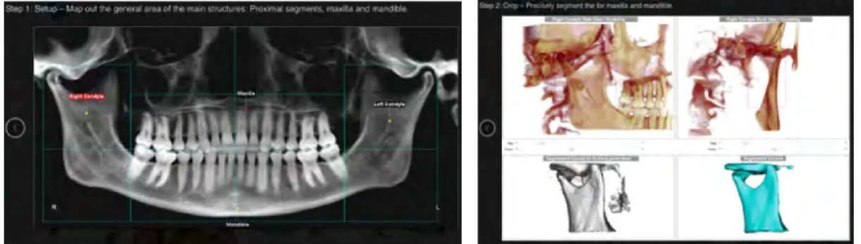 Figure   52   :   exemple   des   possibilités   offertes   par   le   logiciel   Dolphin   Imaging   11.8,   3D   Surgery   ™,   définition   des   régions    d’intérêt   à   gauche