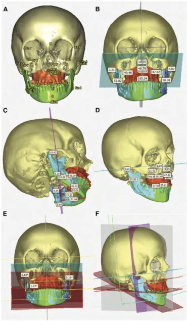 Figure   55   :   exemple   d’analyse   céphalométrique   3D   réalisée   à   laide   de   SimPlant®   O&amp;O   pour   planification   orthognathique    et   comparaison   au   résultat   chirurgical 33       