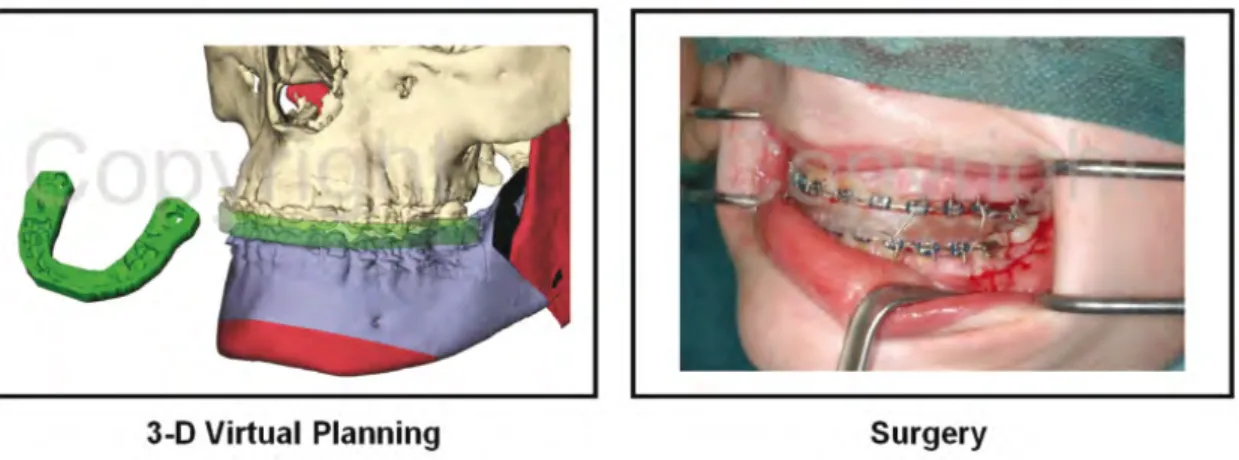 Figure   56   :   exemple   de   modélisation   et   production   de   guide   chirurgical   imprimé   en   3D   par   Medicim 35 