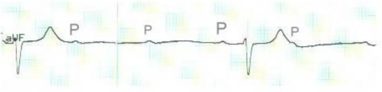 Figure 1.‎ 0.16 Extrasystole Supraventriculaire 