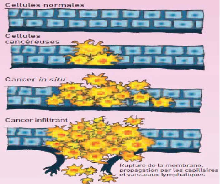 Figure 2 : Cellules cancéreuses 