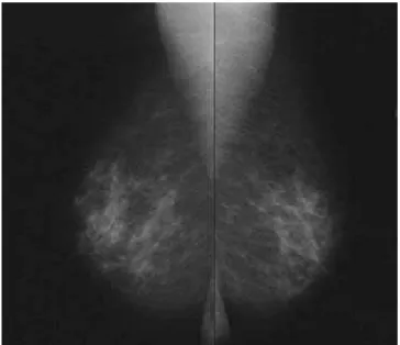 Figure 5 : Cliché de mammographie 