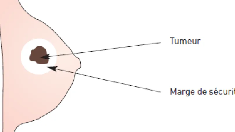 Figure 6 : Chirurgie conservatrice 