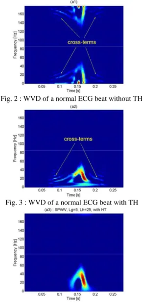 Fig. 2 : WVD of a normal ECG beat without TH 