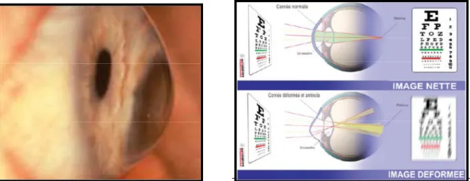 Figure 1.2 : Schéma de la vision avec cornée normale et cornée dé formée[7]