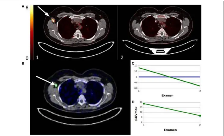 FigUre 7 | example of responder patient classified by sUlTan. First PET showed right axillary lymph nodes hypermetabolism and the second PET,  performed during therapeutic monitoring (review 2), showed a disappearance of the right axillary hypermetabolism