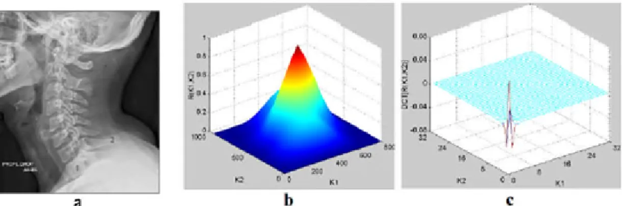 Figure II.12 : a) Image rachis-cervical, b)Auto-corrélation normalisée de l’image rachis- rachis-cervical, c) DCT de l’auto-corrélation normalisée de l’image rachis-cervical.