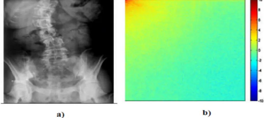 Figure II.13 : a) Image rachis_scoliose, b) DCT de l’image rachis_scoliose