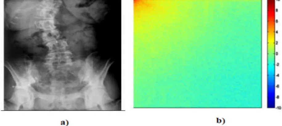 Figure II.13 : a) Image rachis_scoliose, b) DCT de l’image rachis_scoliose