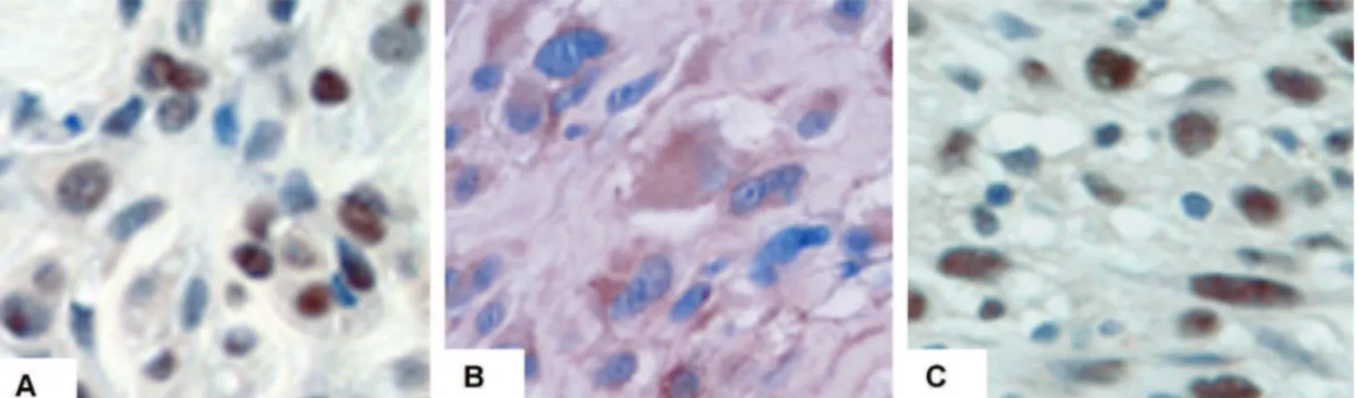 Fig. 1. Representative RANK immunostaining in human osteosarcoma samples. RANK can be localized in the nucleus (A), cytoplasm (B) or concomitantly in both cytoplasmic and nuclear compartments (C) of tumor cells