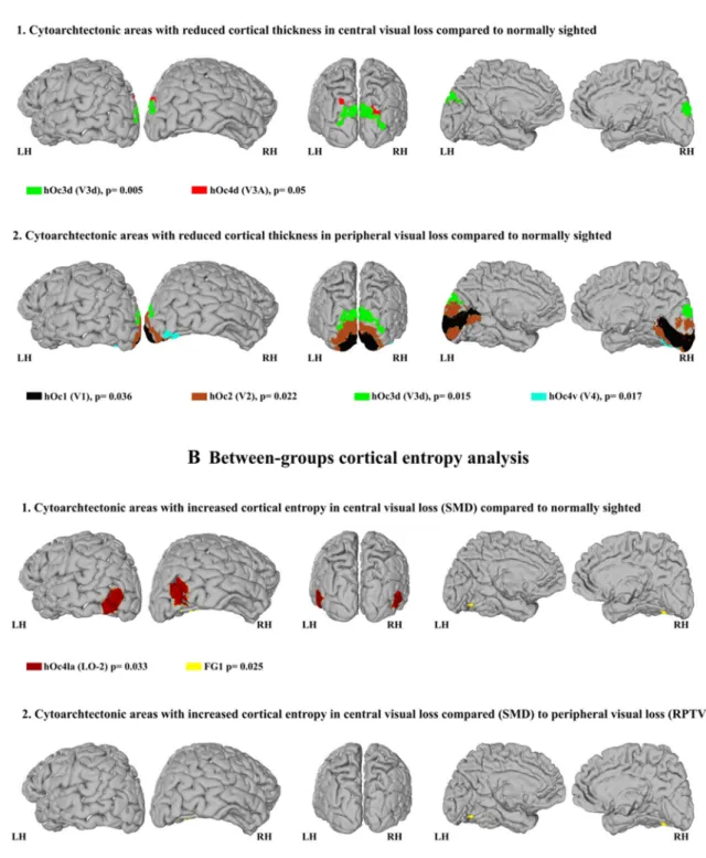 Fig. 1    a Between-group analysis of cortical thickness. b Between- Between-group analysis of cortical entropy
