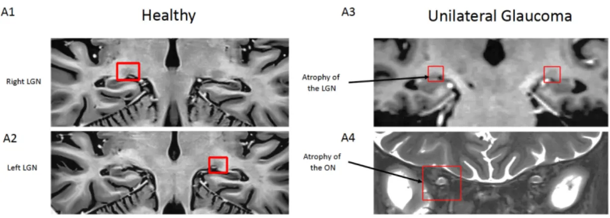 Figure 2. Magnetic resonance imaging (MRI) images of a coronal section of the brain of a healthy  control and a unilateral glaucoma patient