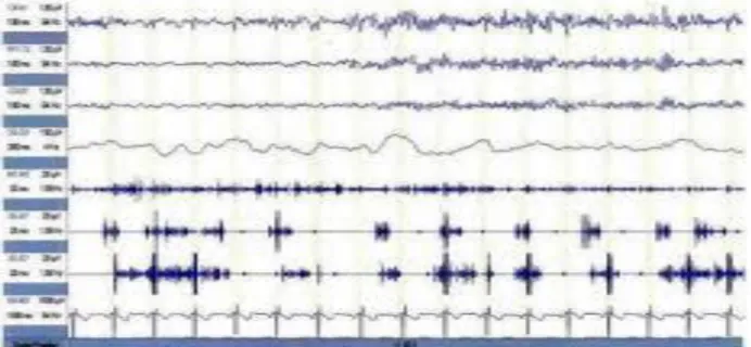 Figure І.3:Exemple d’EEG    